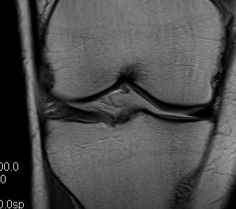 Discoid Meniscus MRI 1